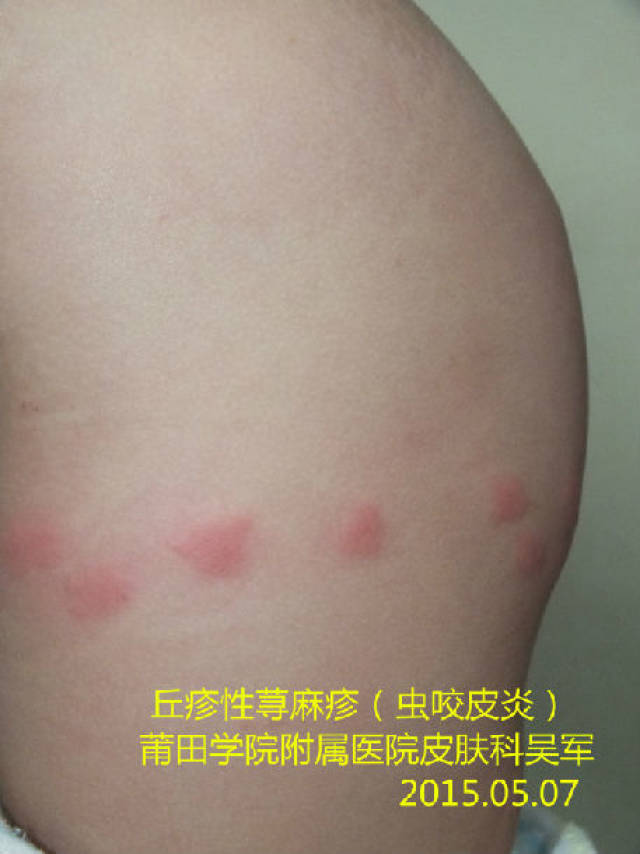 丘疹性荨麻疹(虫咬皮炎)_皮损散 丘疹性荨麻疹(虫咬皮炎)_皮损散