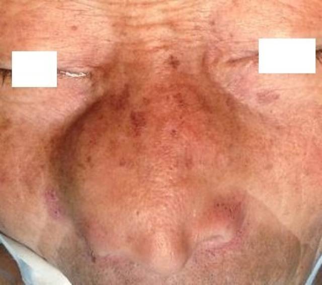 图1.外鼻被鼻腔内充满的息肉挤压变形,谓之"蛙鼻".