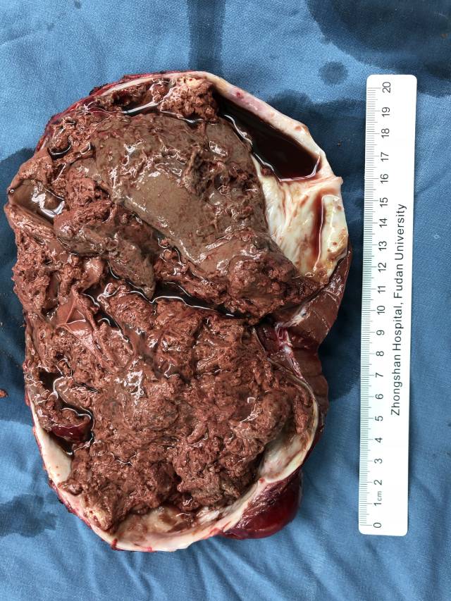 肝脏囊性占位不能忽视