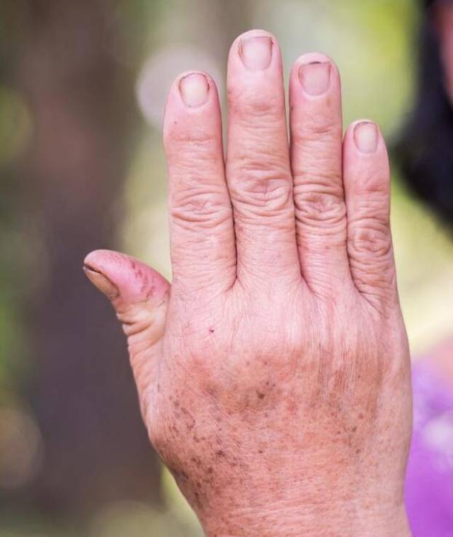 血糖高不高,先看看手,若你没这3个"变化",恭喜,血糖很平稳