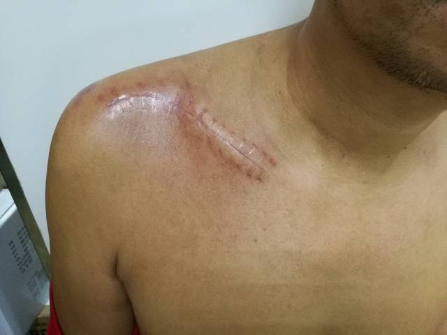 切口常规缝合愈合后