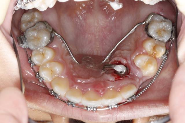 牙齿开窗牵引过程图片图片