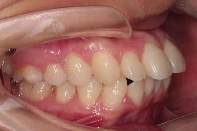 正常人牙齿侧面图片