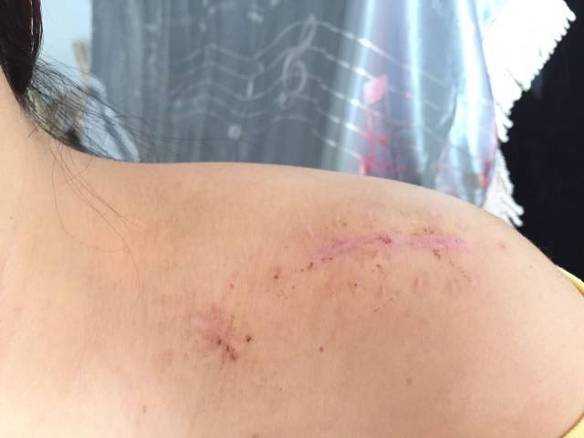 切口或伤口愈合后疤痕问题困扰很多病人,特别是瘢痕体质外伤或术后一