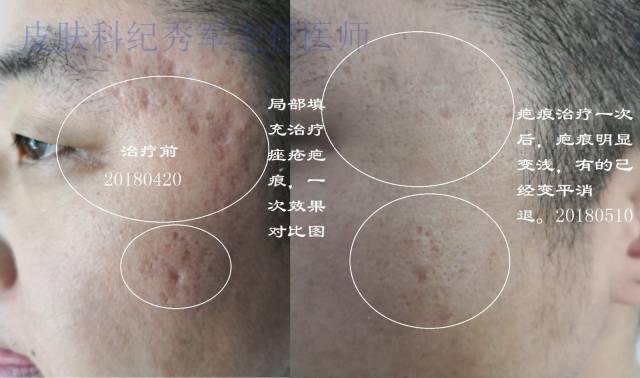 痤疮疤痕治疗三周,前后对比图