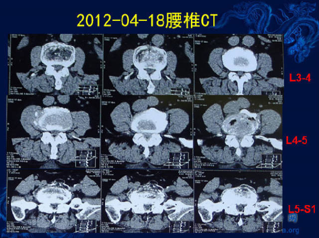 术前腰椎ct提示腰4-5椎管狭窄.