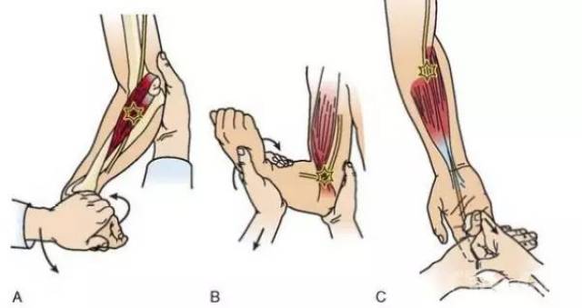 中指屈疼痛指浅屈肌压迫 正中神经需要松解 a.二头肌腱膜 b.指
