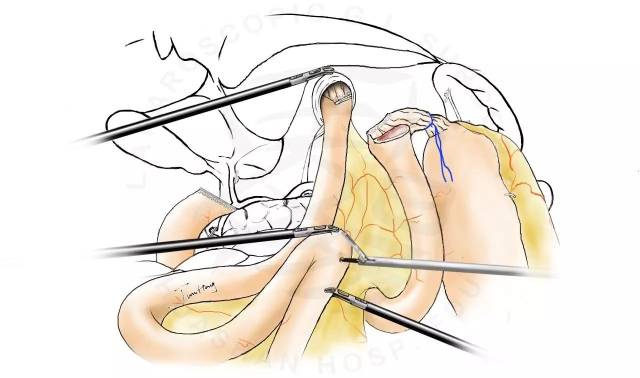 图解splt——全腹腔镜全胃切除后重建的新方式
