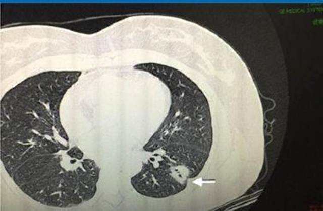 空泡征:空泡征顾名思义是肿物内部大小不等的小的空泡,它是恶性肿瘤的