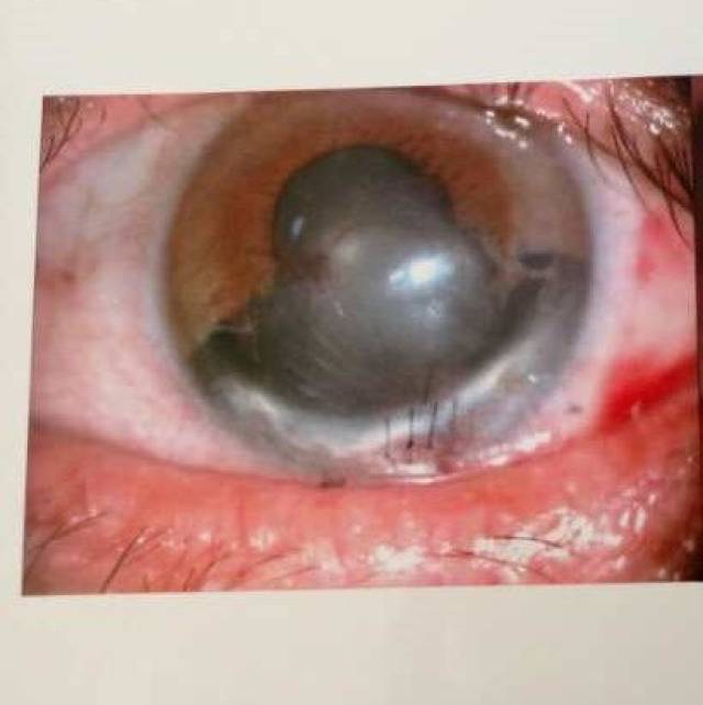 虹膜断离/缺损 瞳孔散大修复的病例