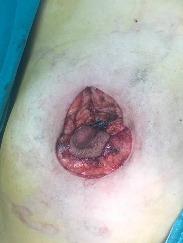 乳腺癌全切术后图片图片