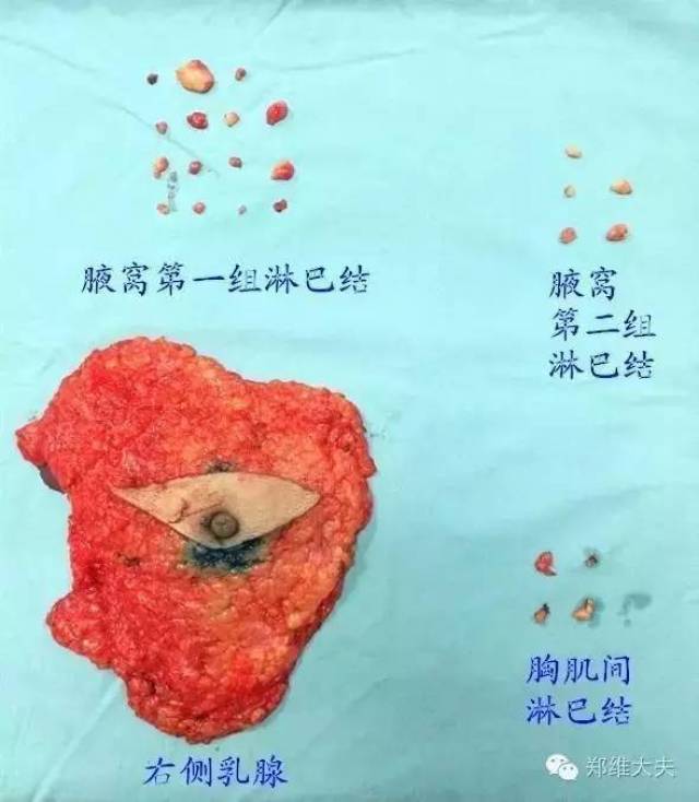 乳腺癌手術的點滴思考