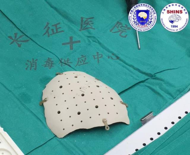 颅骨缺损怎么办?补!——颅骨修补病例及相关科普