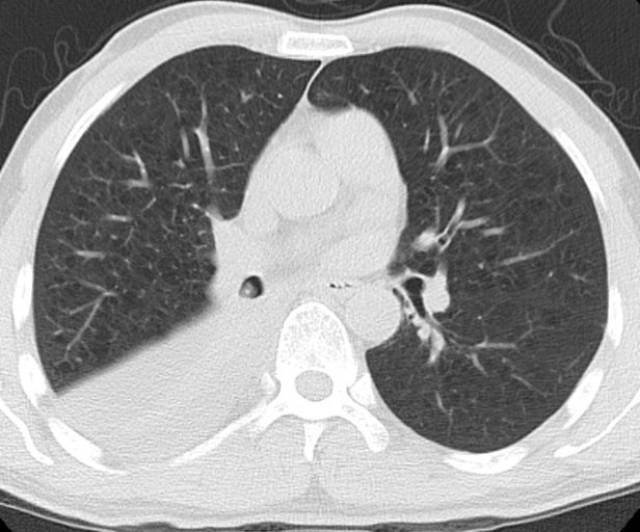 肺癌的主要病理类型及典型ct表现
