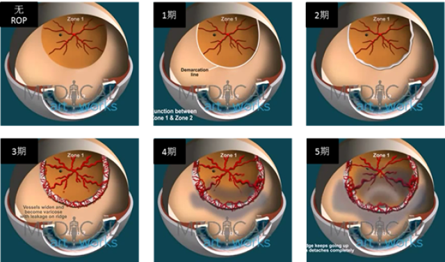 早產寶寶視網膜新生血管生長的過程,就是我們所說的早產兒視網膜脖潷