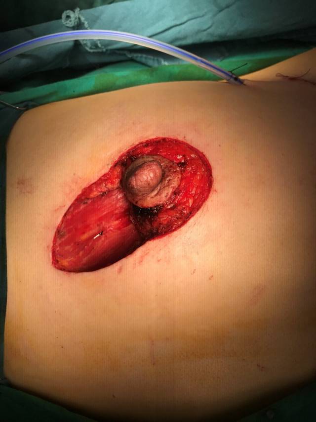 乳腺癌真人手术后图片图片