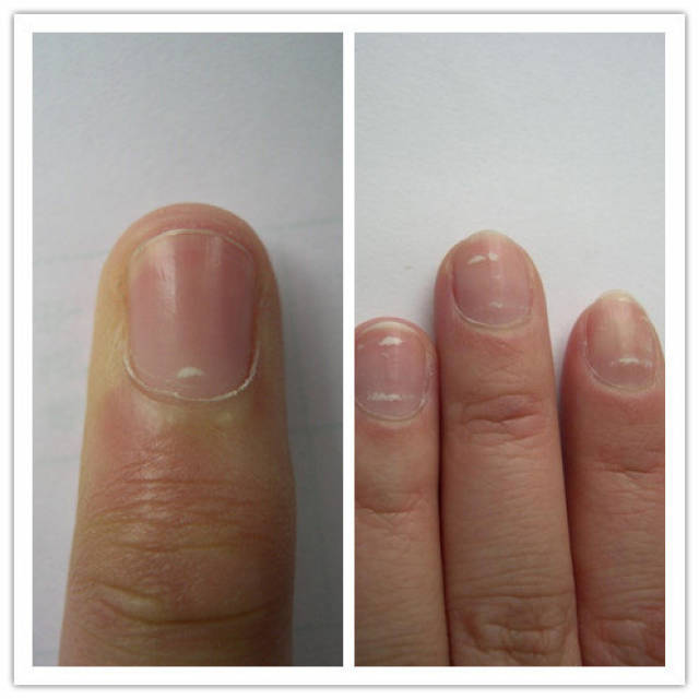 指甲白点你需要知道这些