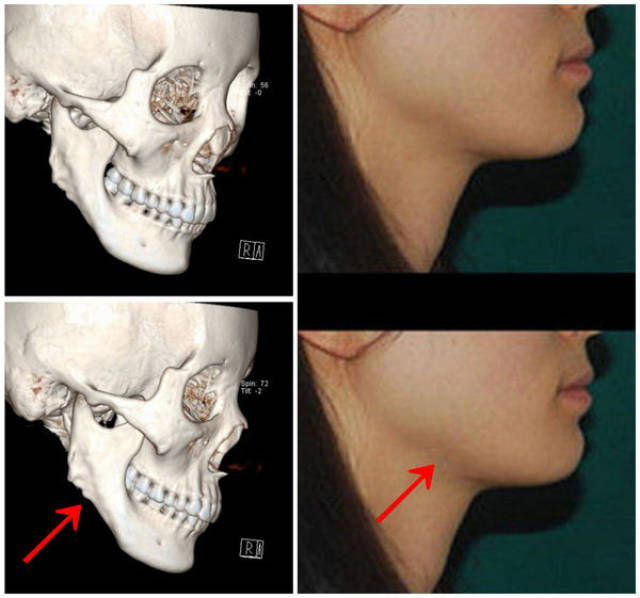 下頜角切除後第二下頜角產生的原因及處理手段
