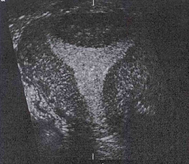 弓形子宫的矫形手术