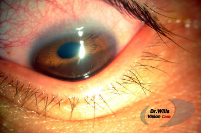 重度圆锥角膜rgp矫正一例