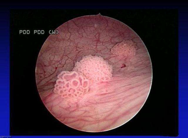 膀胱癌晚期图片图片