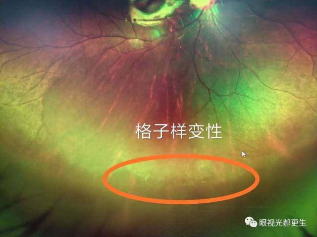 近视检查为什么医生要求眼底照相?