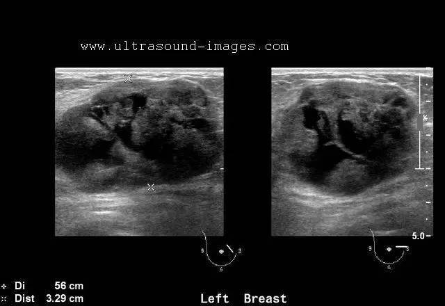 乳腺叶状肿瘤图片
