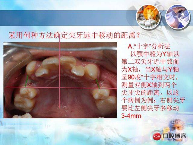 尖牙关系分为哪三种图片