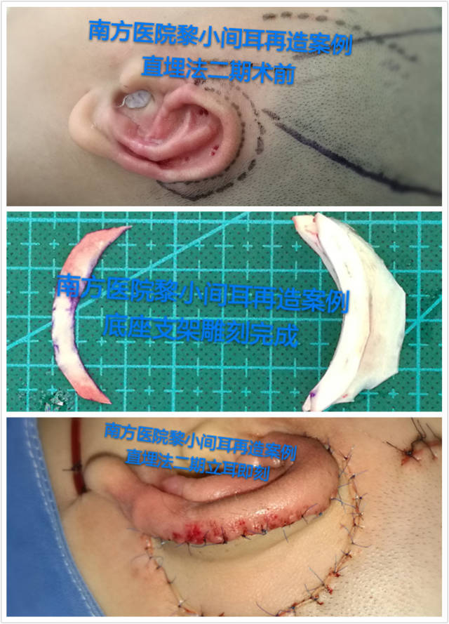 直埋法小耳再造