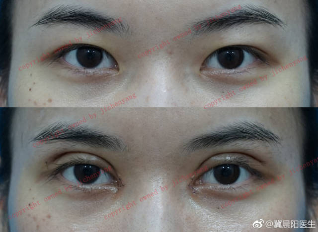 冀晨阳眼部整形(双眼皮,上睑下垂,眼综合,眼修复)案例