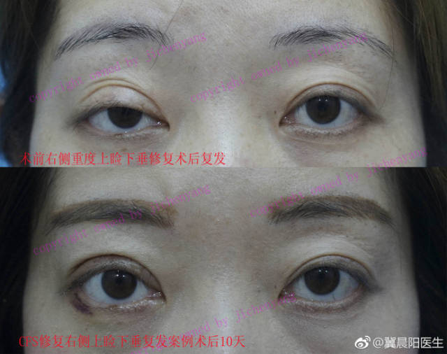 冀晨阳眼部整形(双眼皮,上睑下垂,眼综合,眼修复)案例
