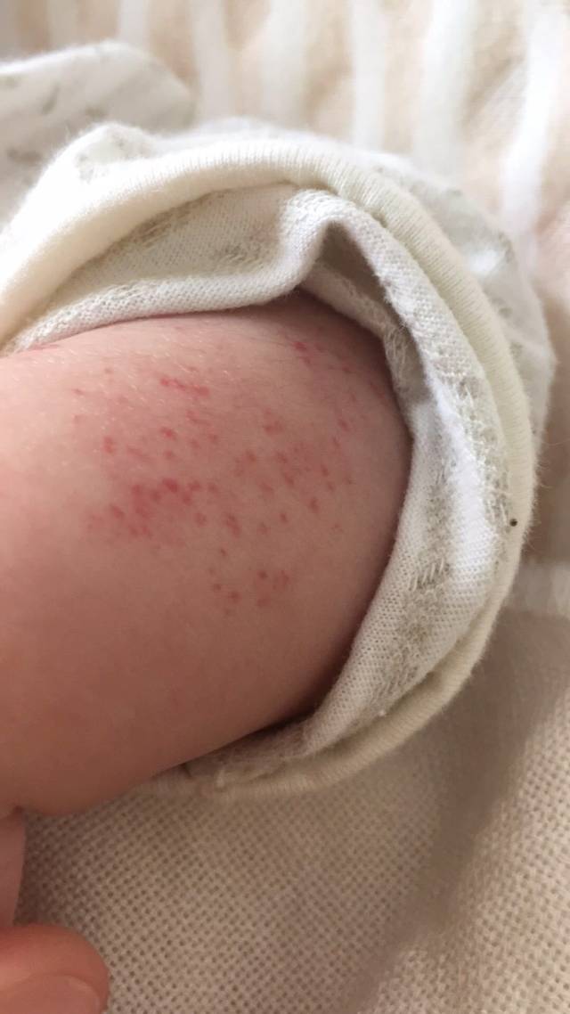 血管瘤图片,治疗血管瘤医院排名,最好的医院,最好治疗方法.