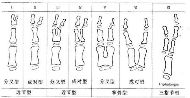 拇指多指畸形的wassel分型_手机搜狐网