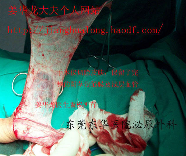 精准医疗时代,包皮环切已out,现在最好是包皮整形!