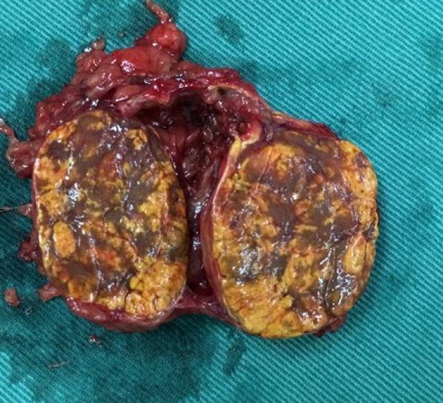 无功能肾上腺腺瘤需要手术吗?_手机搜狐网