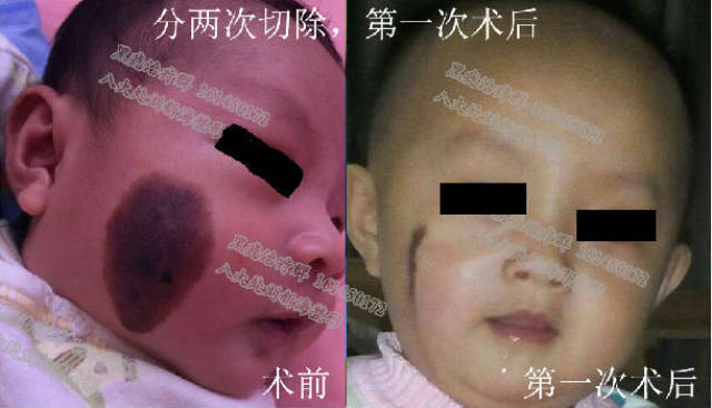 面部较大面积黑痣切除手术效果图