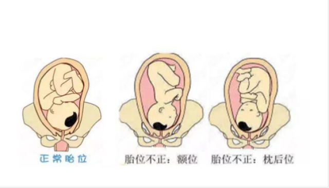 胎心在左边胎儿姿势图图片