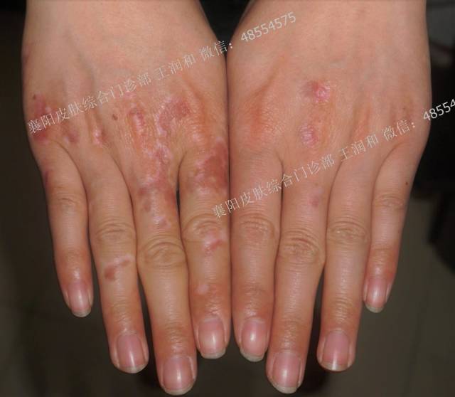 一文看懂白癜风表皮移植手术全过程(附注意事项)