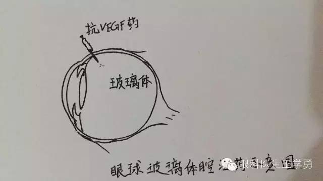 球结膜注射图解图片