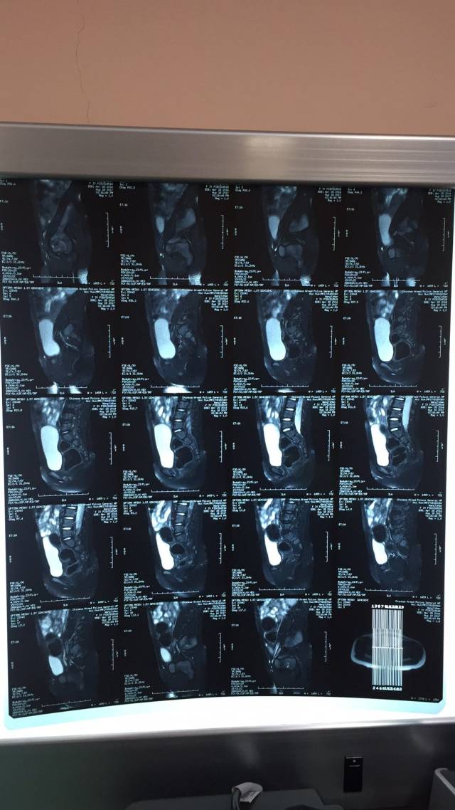 3歲女孩兒復發骶尾部惡性生殖細胞瘤