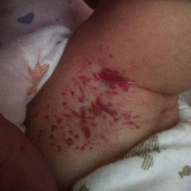 血管瘤图片,治疗血管瘤医院排名,最好的医院,最好治疗方法.