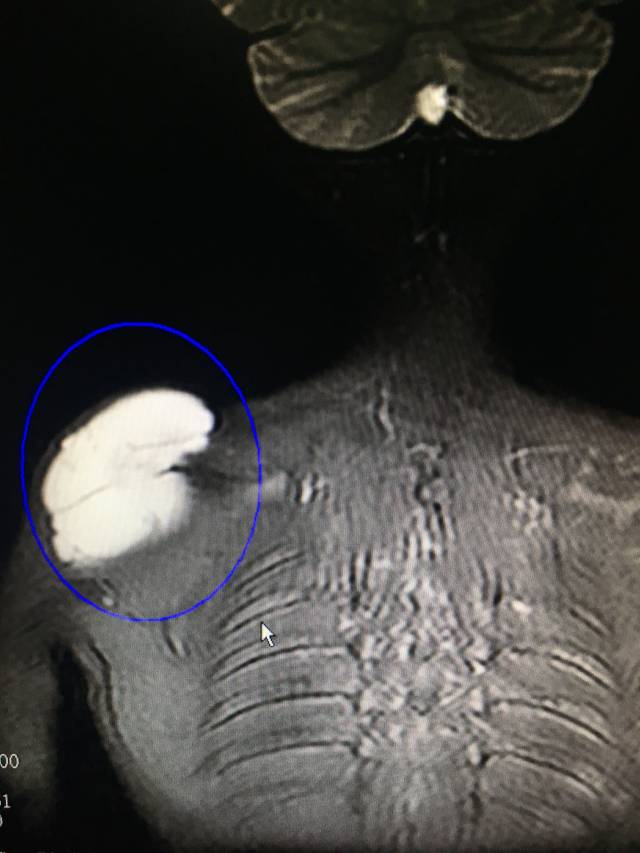 淋巴管瘤,淋巴管畸形如何治疗,能根治吗,会复发吗,留疤吗.