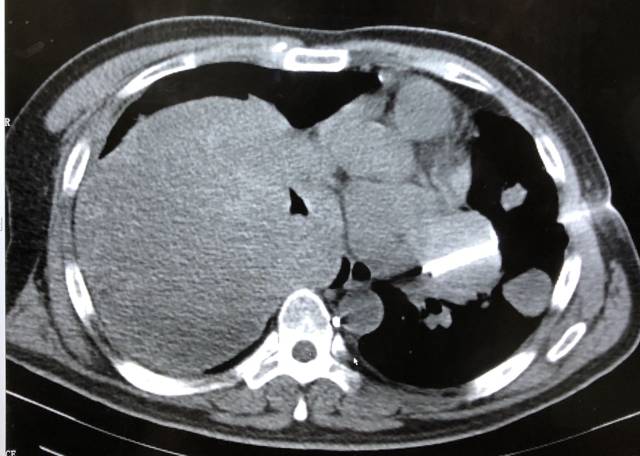 粒子植入治疗针穿刺病灶
