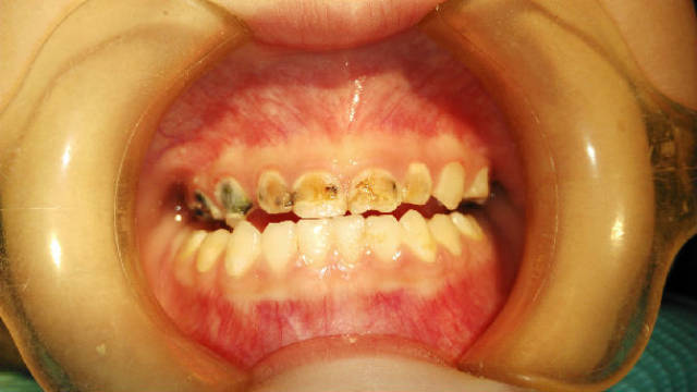 牙齿冠状面图片