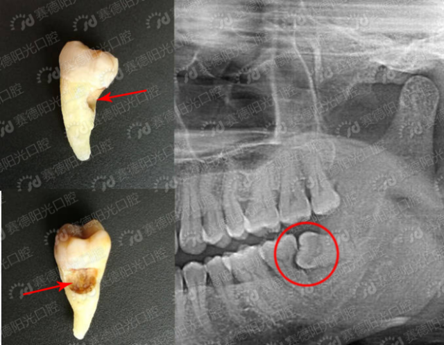(邻牙向缺牙处倾斜,导致缺隙处恒牙萌出受阻) 4,如果第三恒磨牙(智齿)