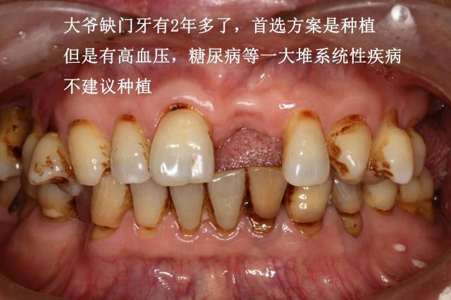 前牙全瓷固定橋修復