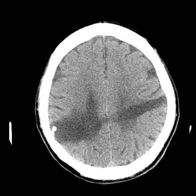 头颅ct示:子弹贯通伤!