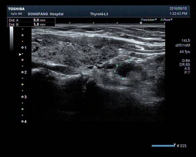 上图可以看到桥本甲状腺炎的患者超声图像上腺体饱满,增生明显,腺体内