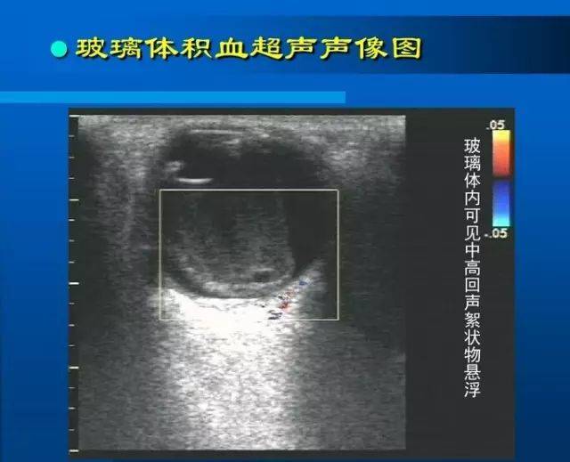 眼部b超常见病的图像及诊断