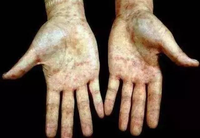 【警惕】80岁老伯洁身自好多年,竟然被查出严重梅毒!